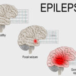  (Epilepsy)